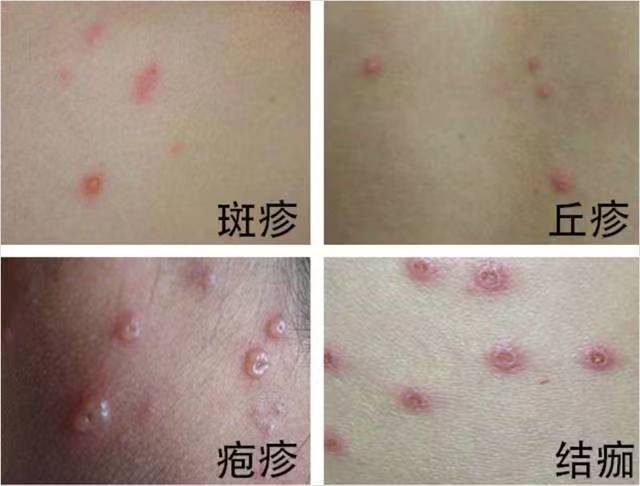 水痘1.jpg